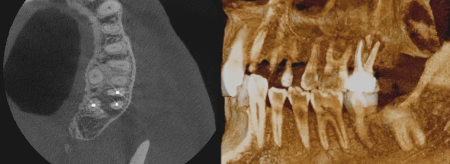 Scanning med CBCT med tværsnit og tredimensionel visualisering af tænder og kæbe